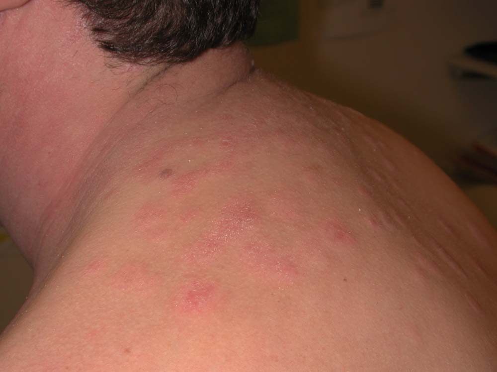 psoriasis