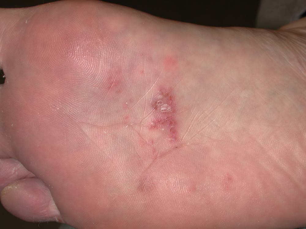 tinea pedis