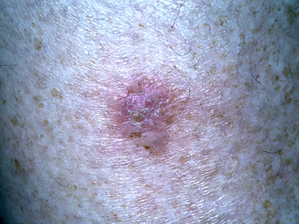 actinic keratosis