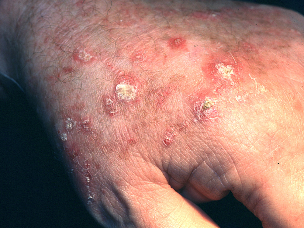 actinic keratosis