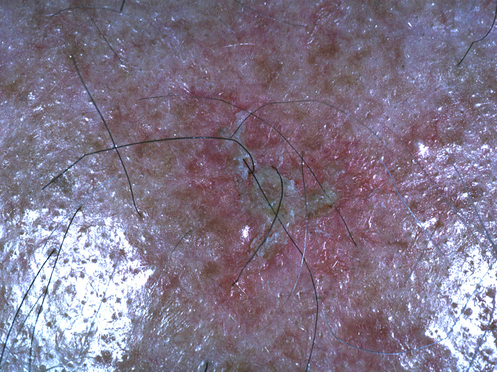 actinic keratosis