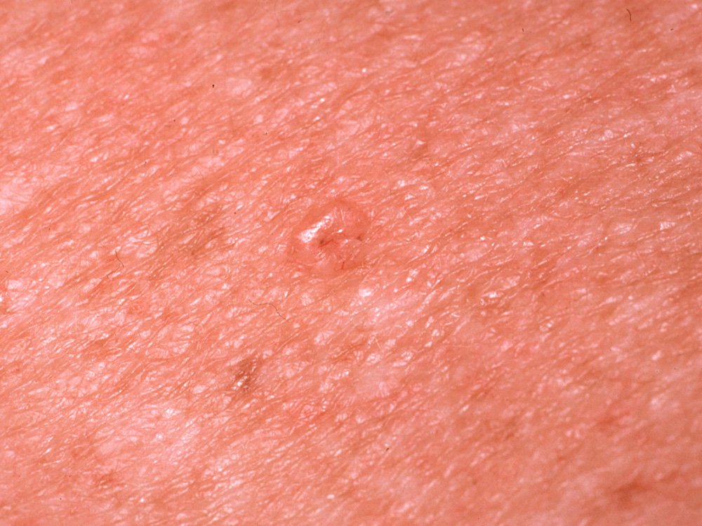 basal cell carcinoma, nodular