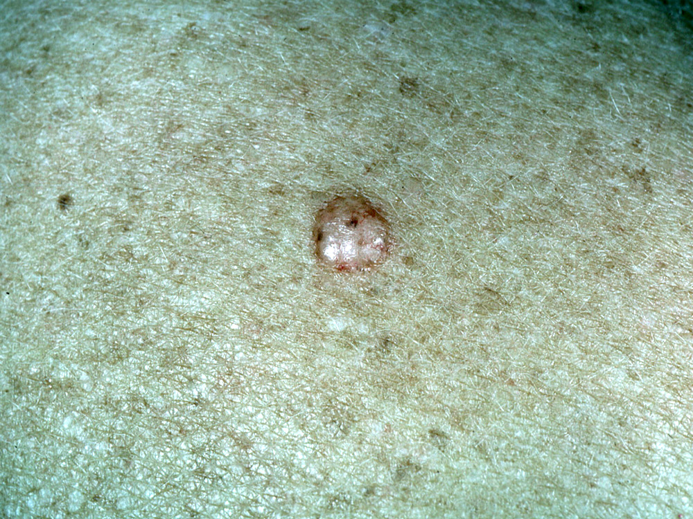 basal cell carcinoma, nodular