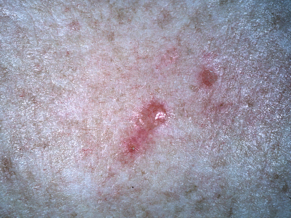 basal cell carcinoma, nodular