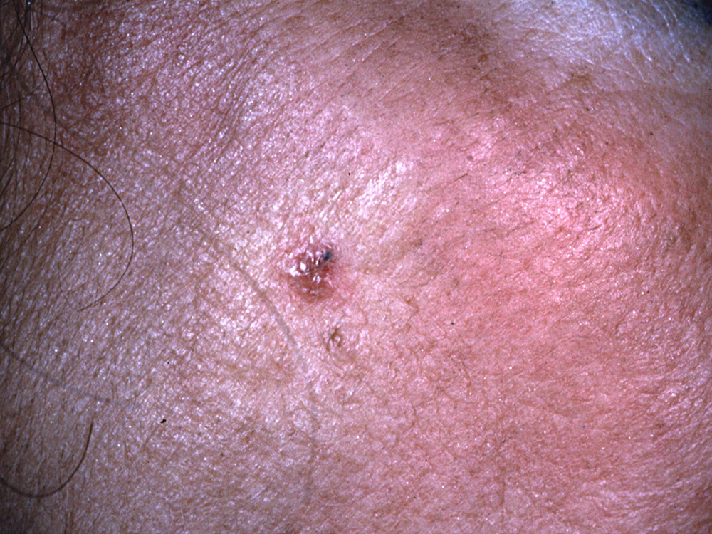 basal cell carcinoma, nodular