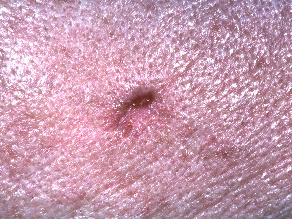 basal cell carcinoma, nodular