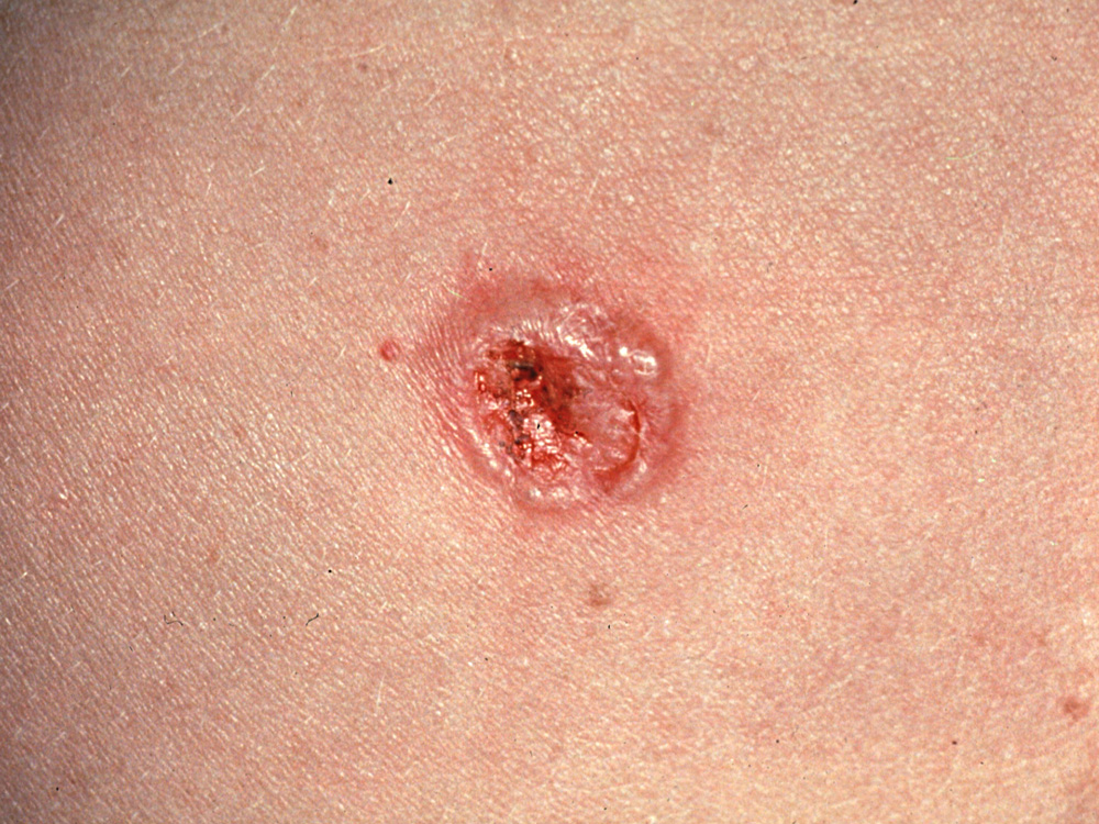 basal cell carcinoma, nodular