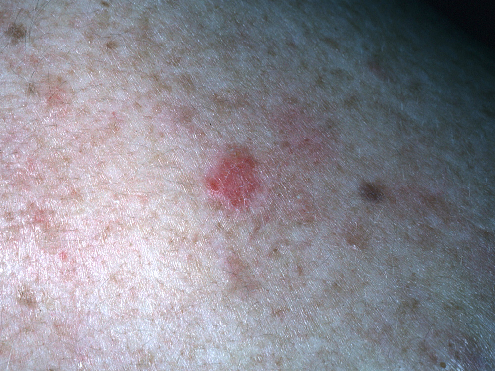 basal cell carcinoma, nodular