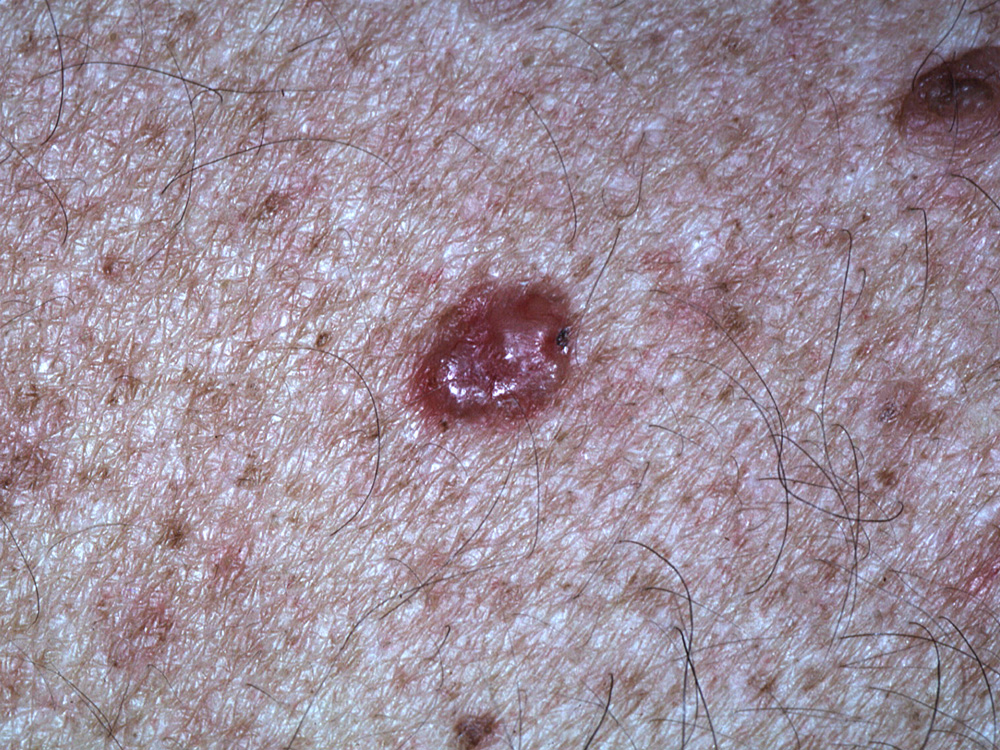 basal cell carcinoma, nodular