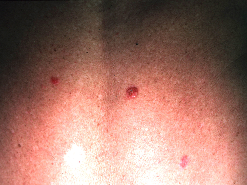 basal cell carcinoma, nodular