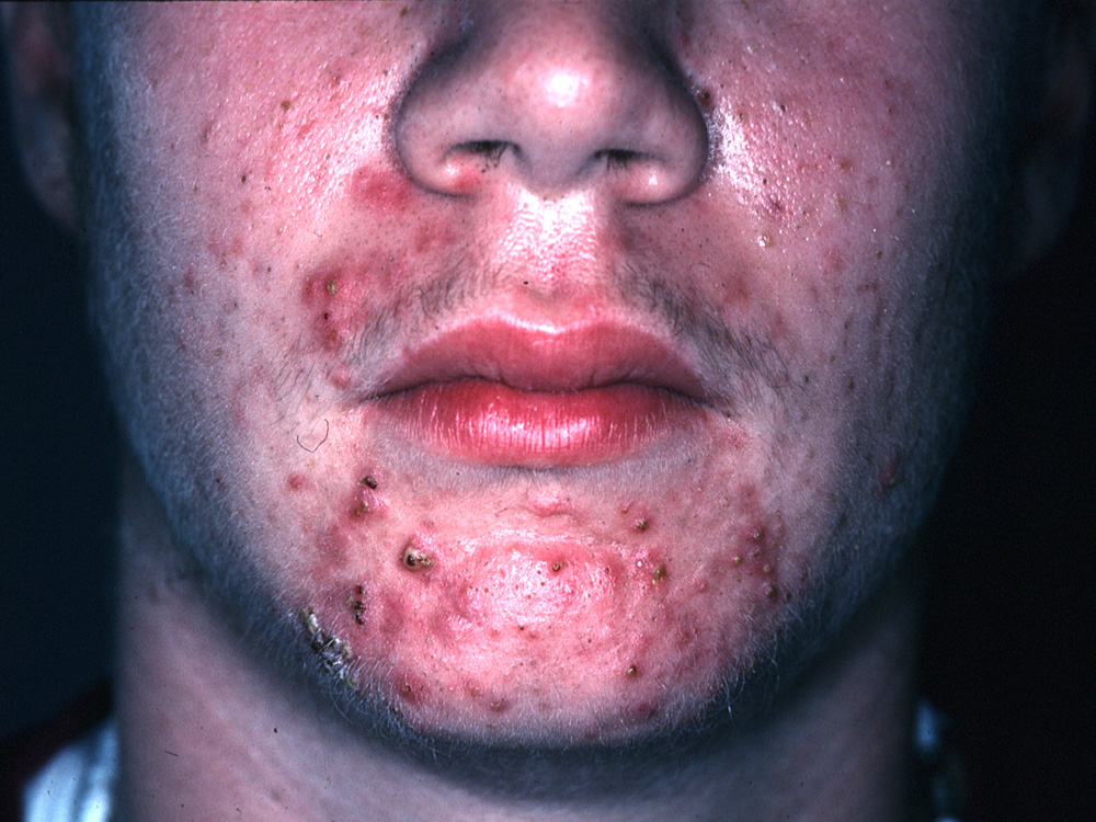 acne
