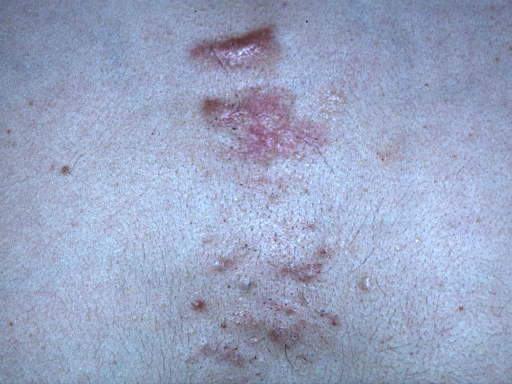 acne keloidalis scars 