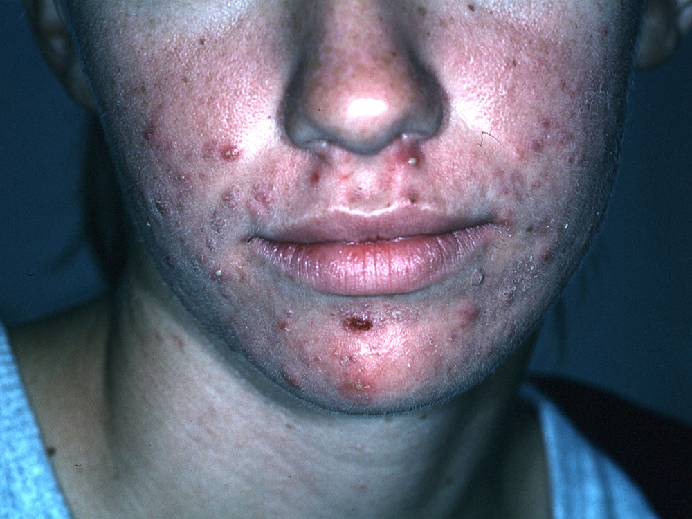 acne