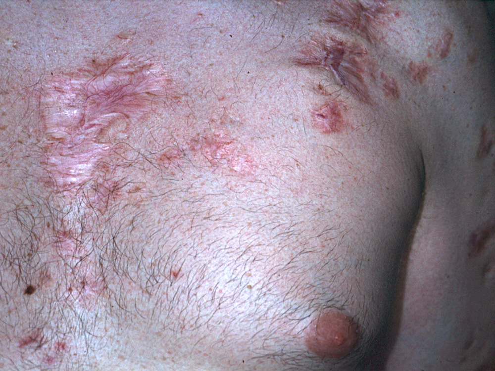 acne keloidalis scars 