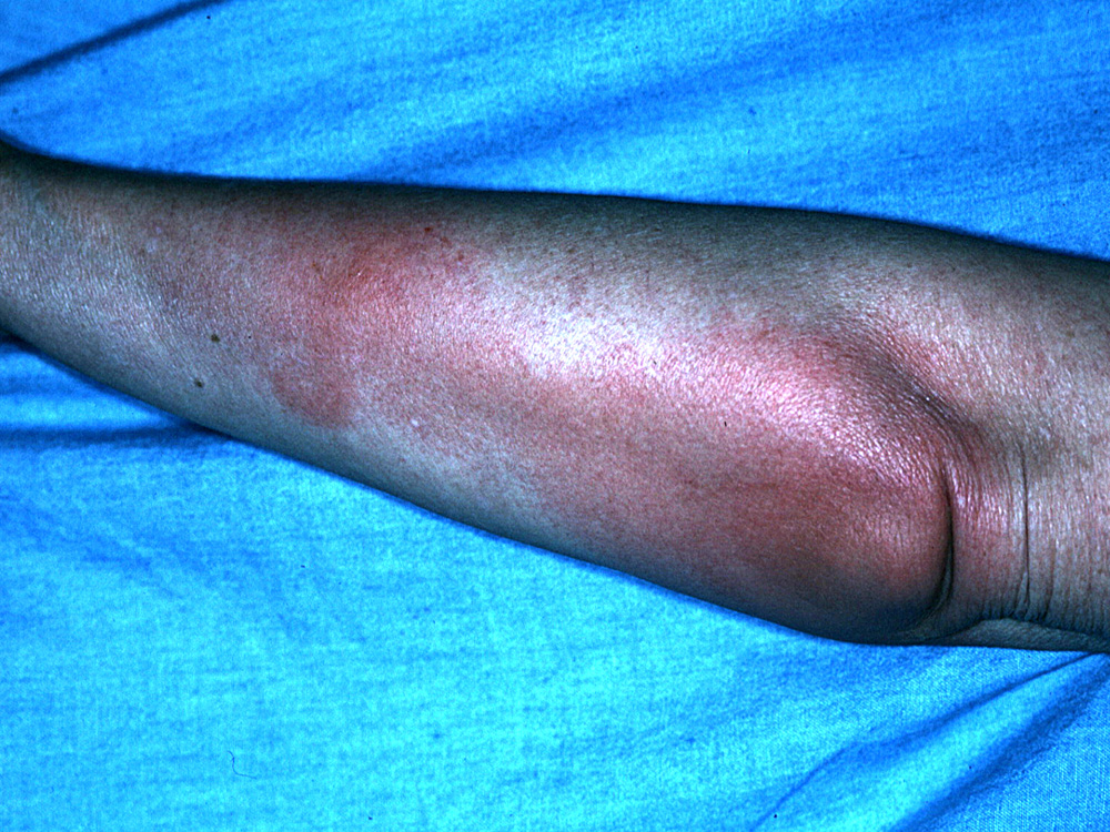 cellulitis