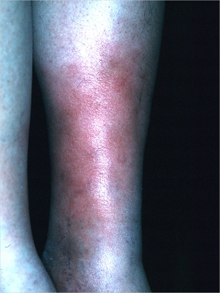 cellulitis