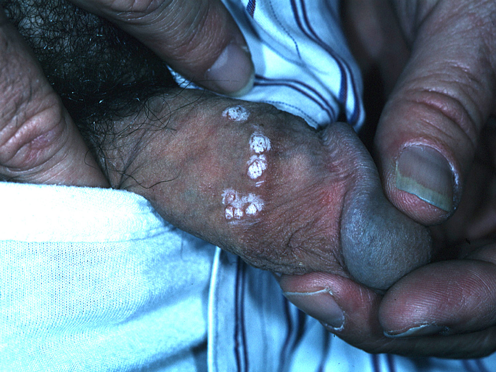 warts, genital