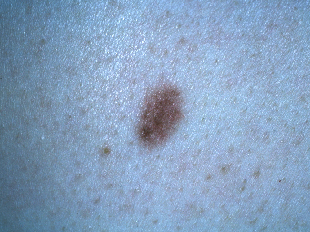 nevus, dysplastic
