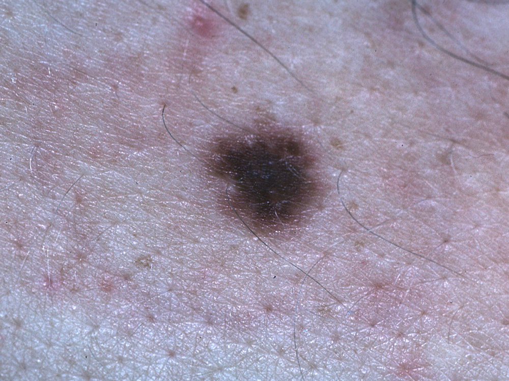 nevus, dysplastic