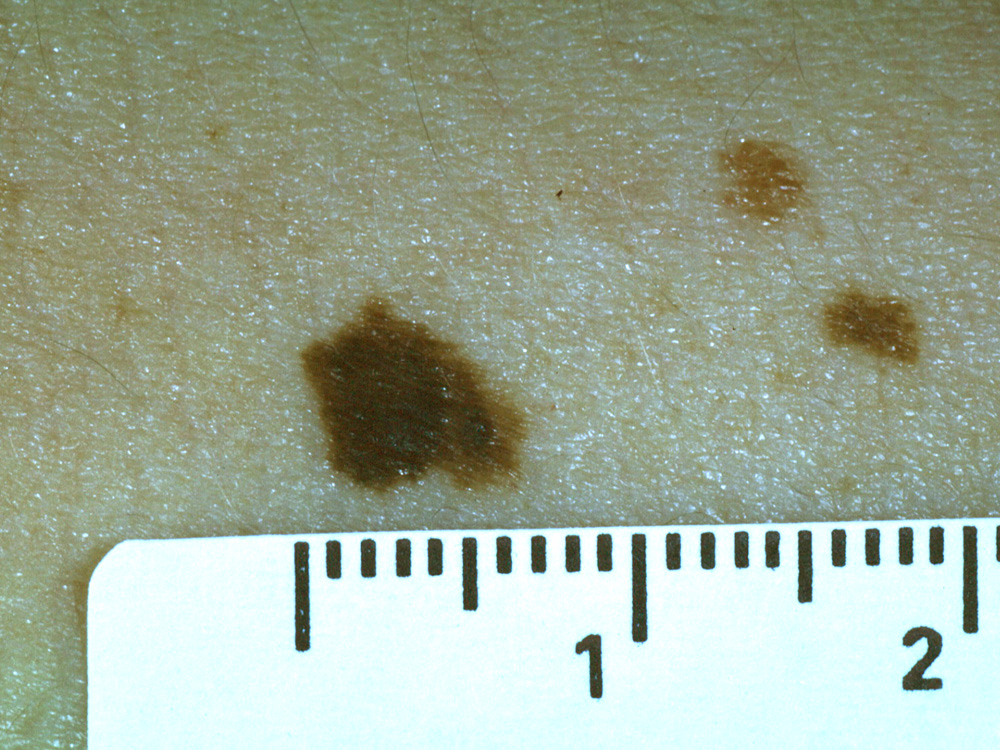 nevus, dysplastic