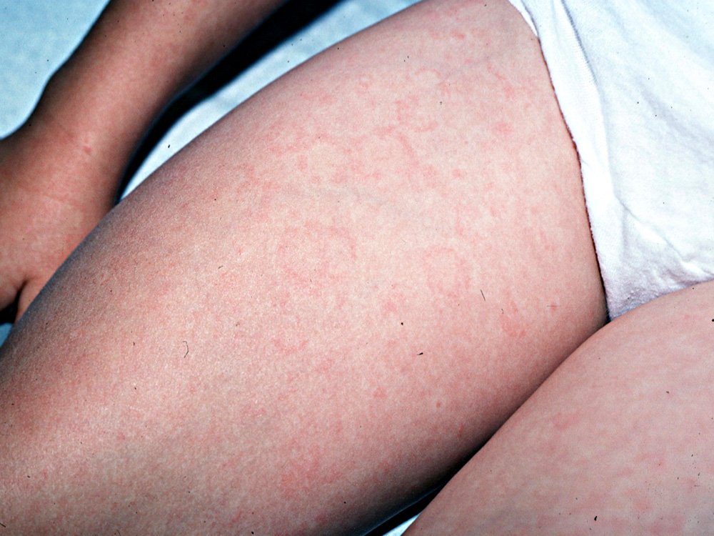 erythema annulare centrifugum