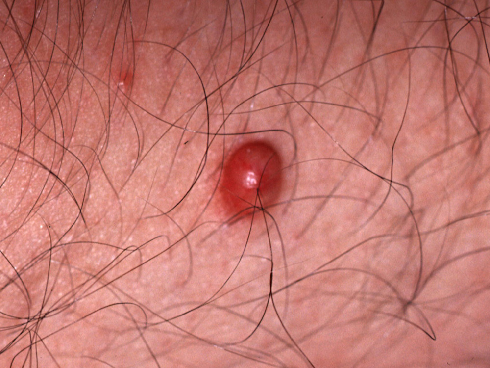 cyst, epidermal