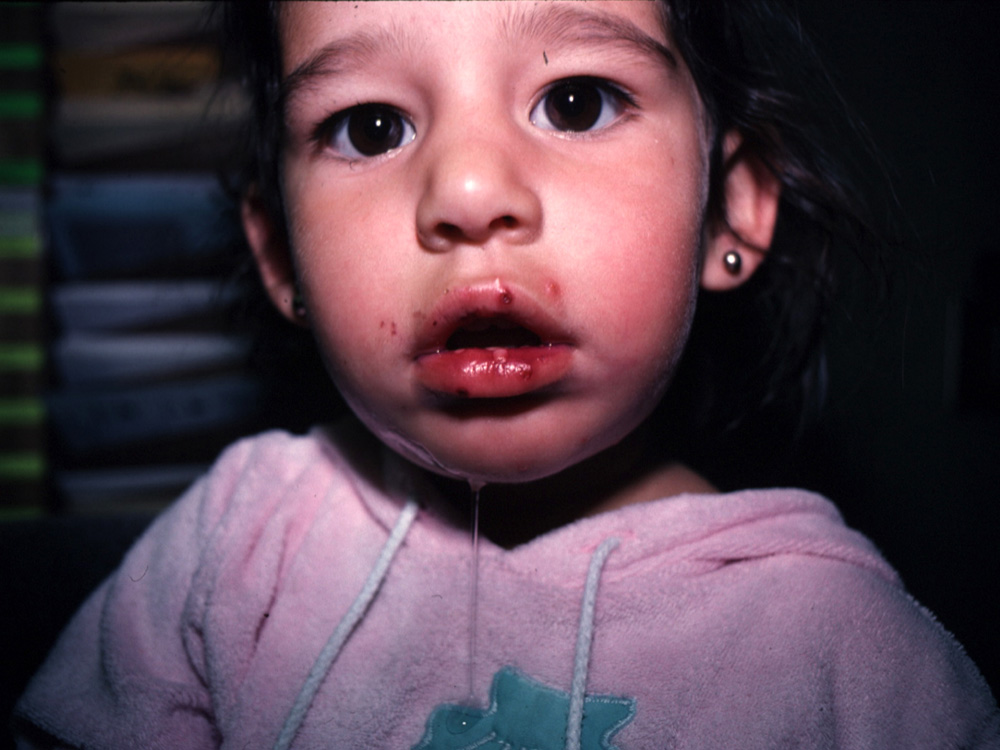 herpes simplex type I