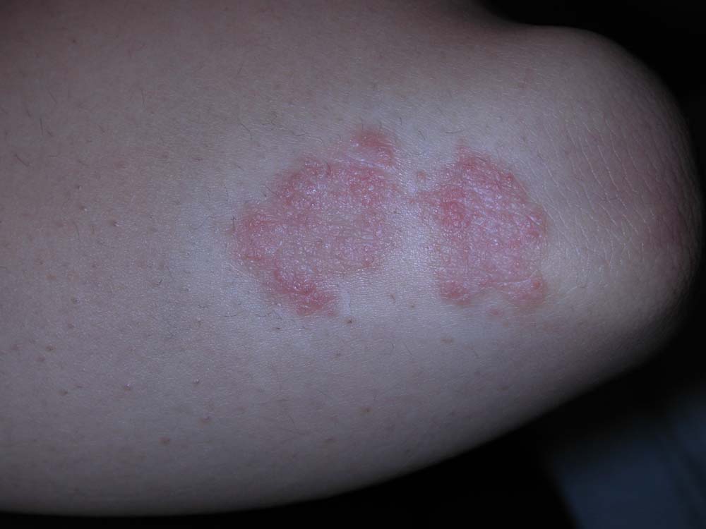 psoriasis