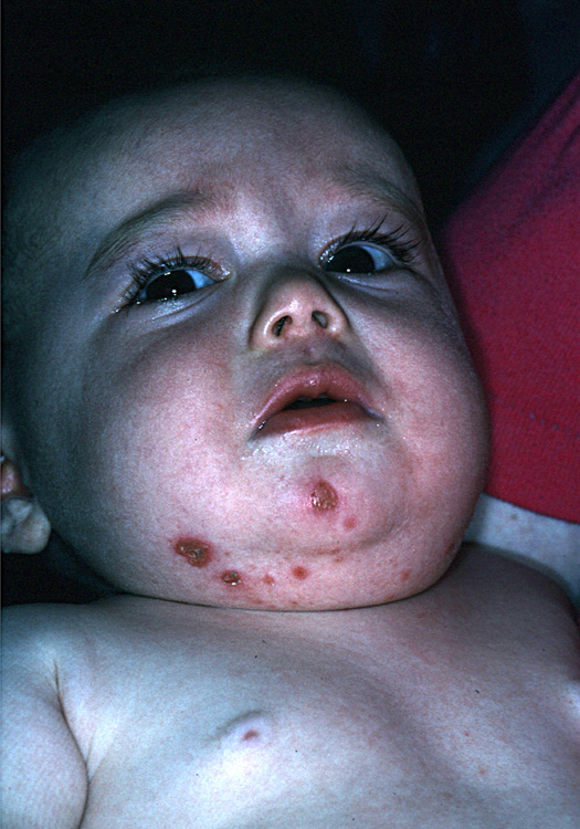 impetigo