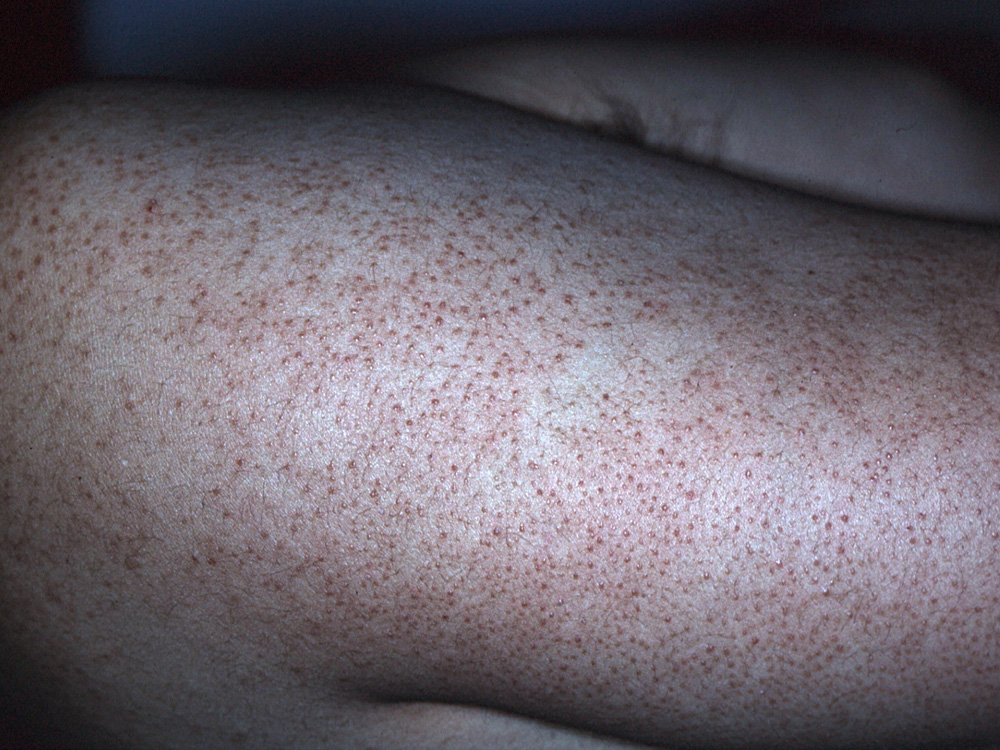 keratosis pilaris