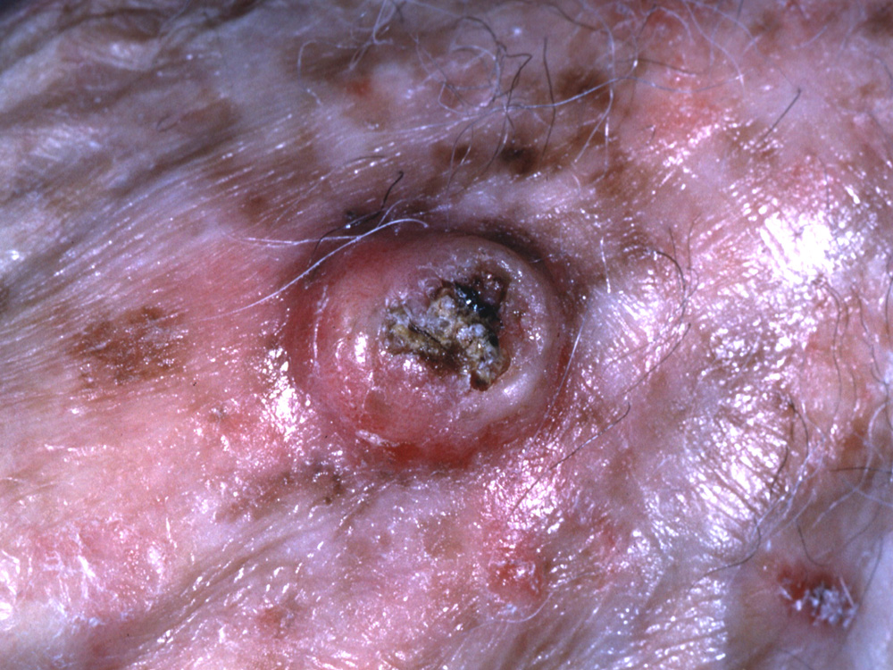keratoacanthoma