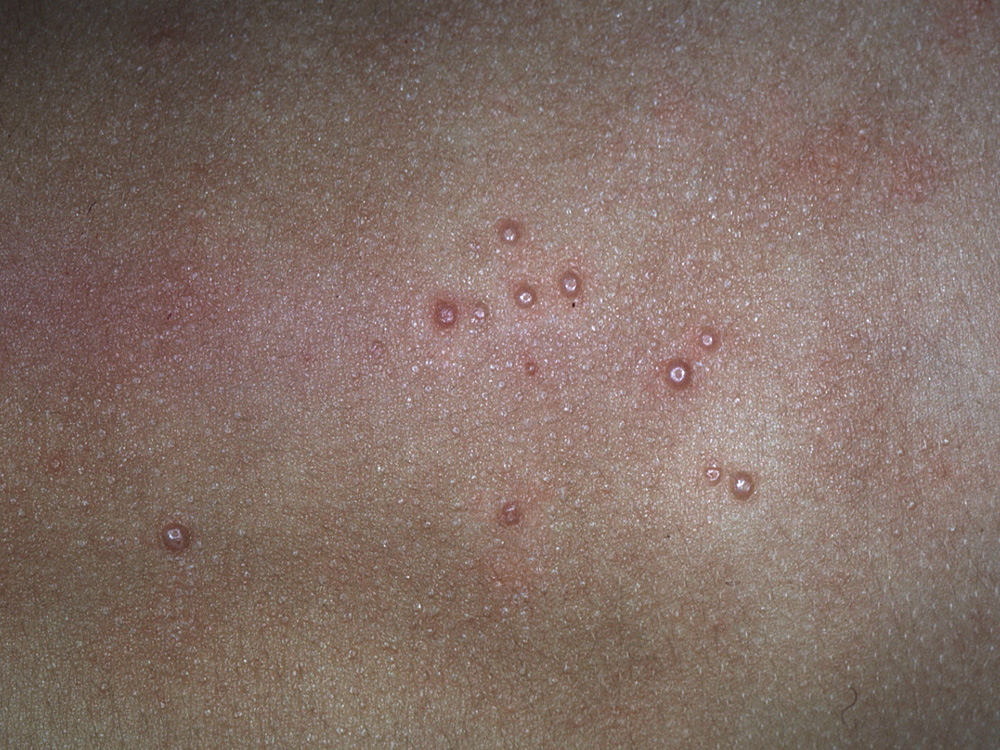 molluscum contagiosum