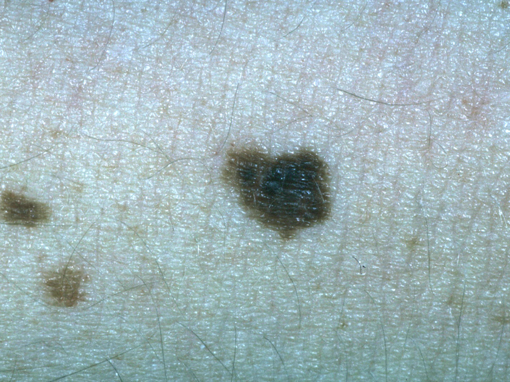 nevus, dysplastic