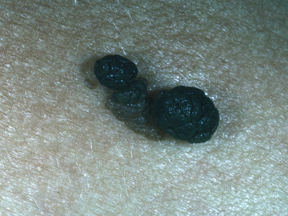 nevus, dermal