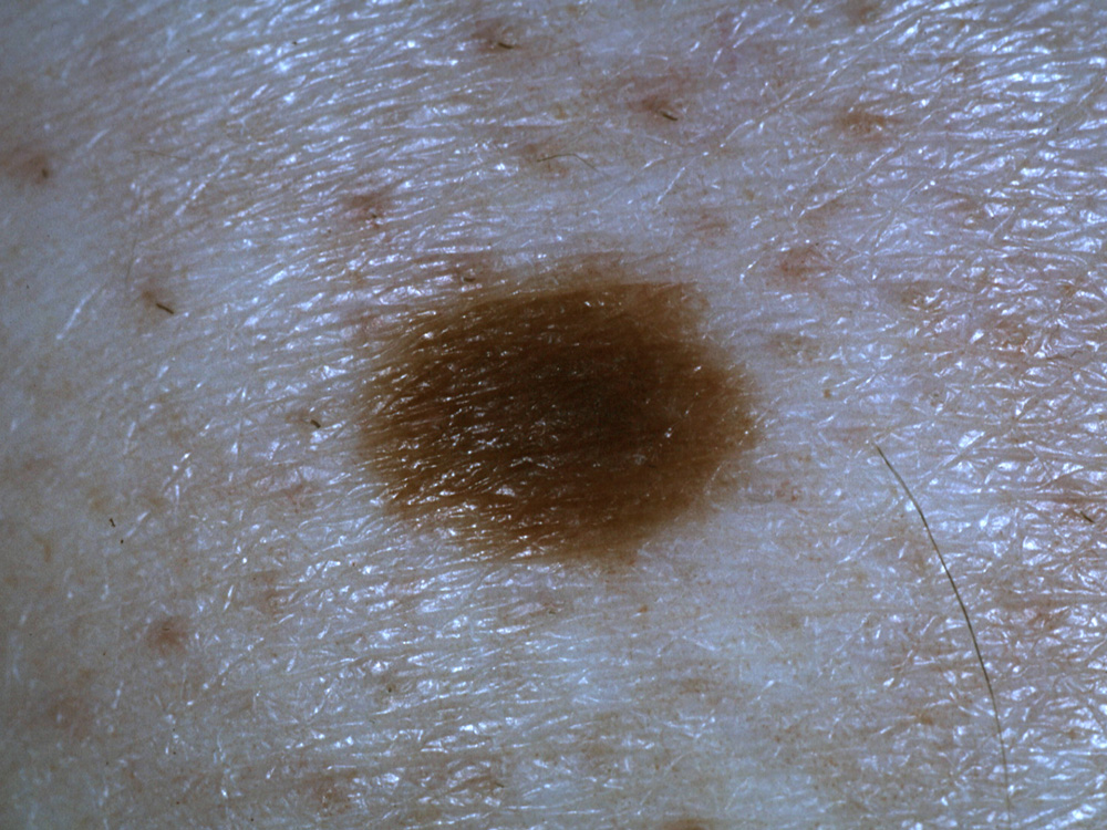 nevus, dermal