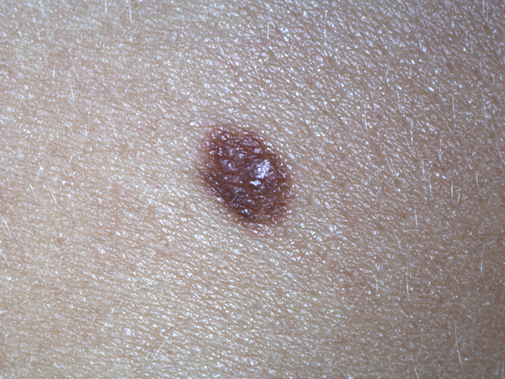 nevus, dysplastic