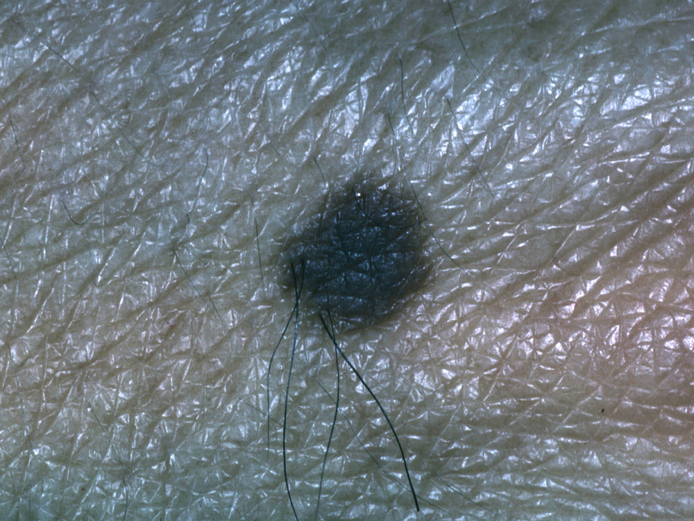 nevus, congenital