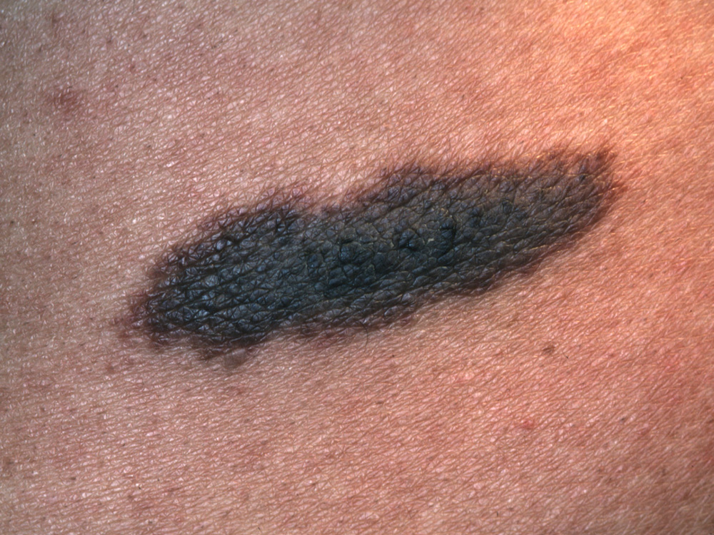 nevus, congenital