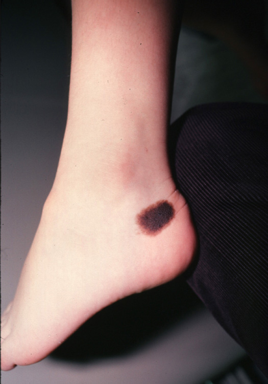nevus, congenital