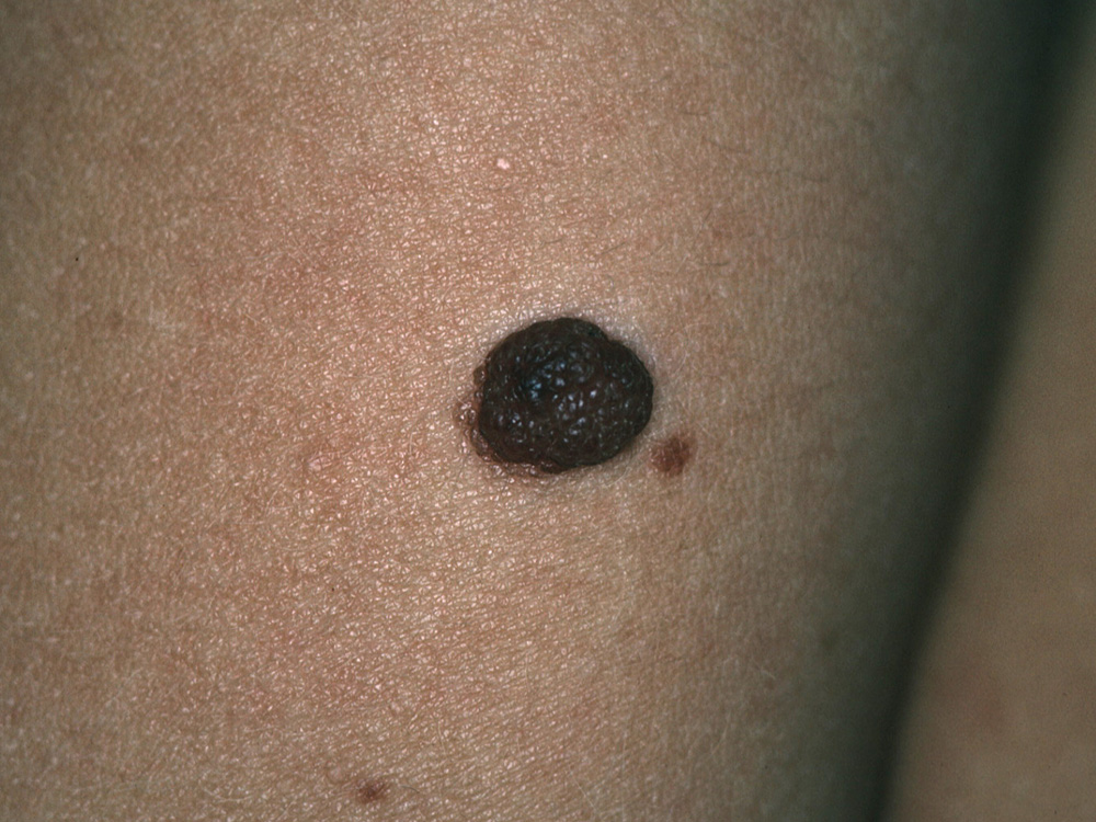 nevus, dermal