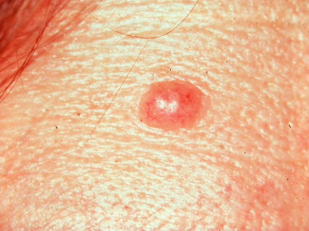 nevus, dermal