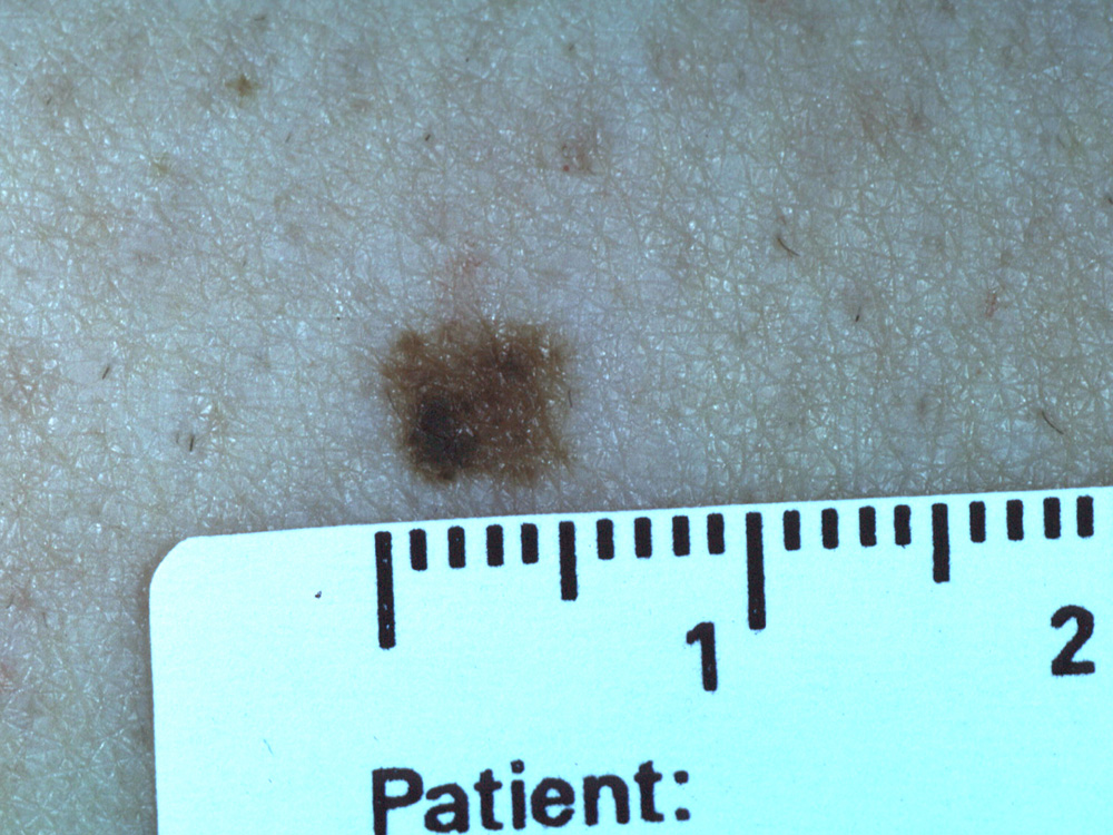 nevus, dysplastic