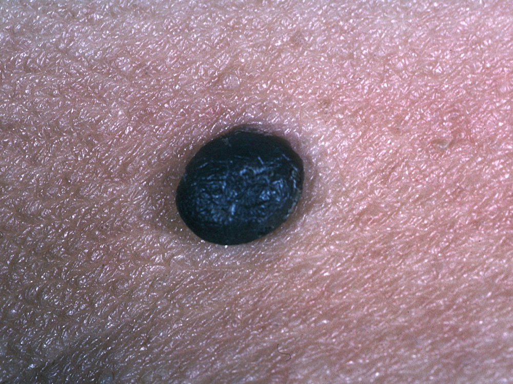 nevus, dermal