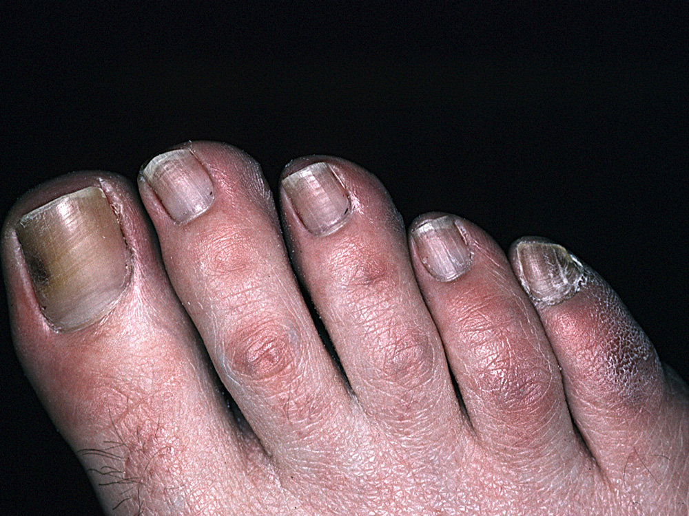 onychomycosis