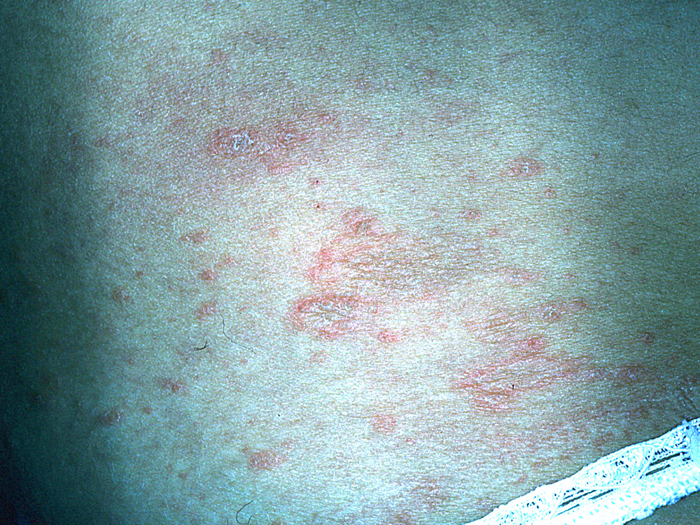 pityriasis rosea