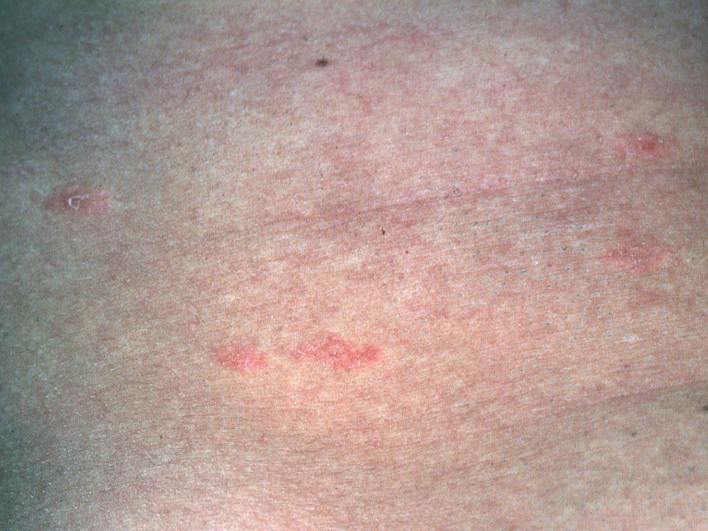 pityriasis rosea