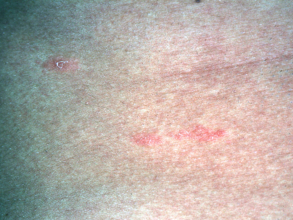 pityriasis rosea