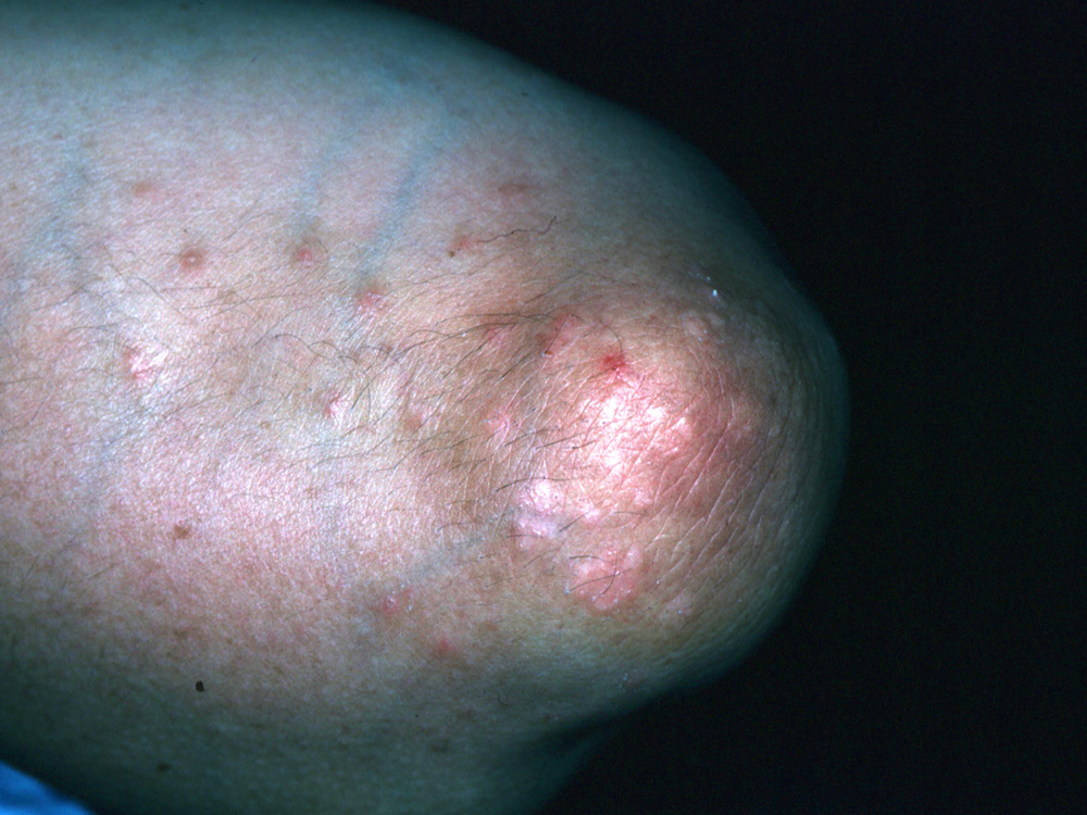 psoriasis