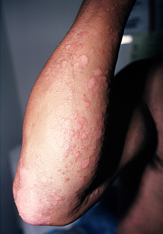 psoriasis