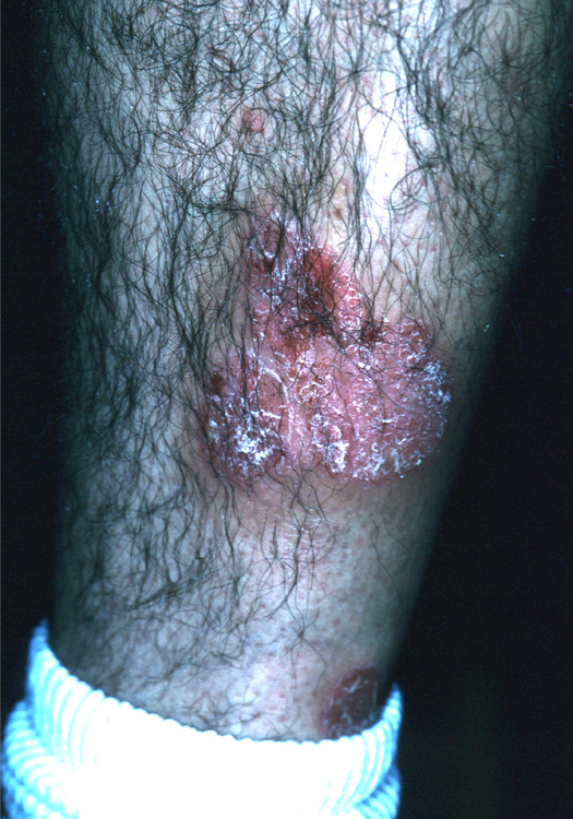 psoriasis